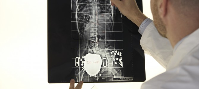 Radiografie per scoliosi: quanto fanno male? Radiografie per scoliosi: quanto fanno male?