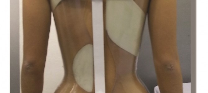 Il corsetto Sforzesco: il corsetto super rigido per la scoliosi Il corsetto Sforzesco: il corsetto super rigido per la scoliosi